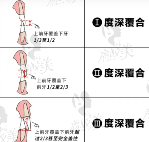 北京牙齿深覆合矫正多少钱