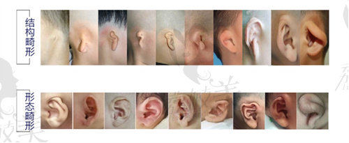 小耳畸形半包和全包的区别