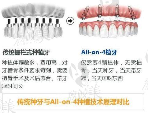 传统种植牙和AL-ON-4种植牙技术对比