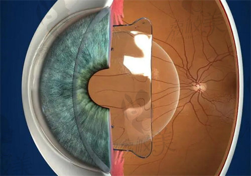 美国眼力健三焦点人工晶体价格