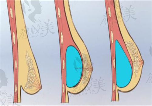 李高峰術(shù)中全程使用內(nèi)窺鏡+<span style=