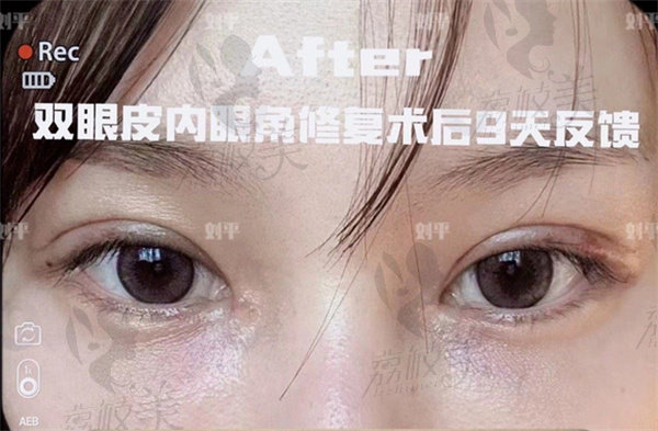 上海刘平修复双眼皮好吗？