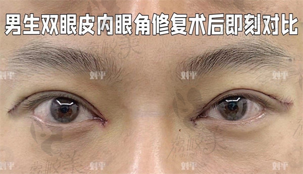 上海刘平修复双眼皮好吗？