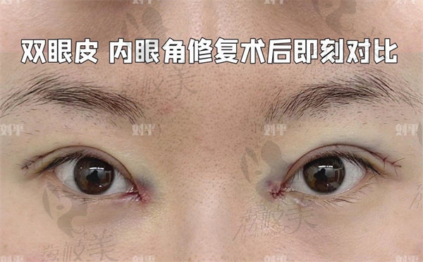 上海刘平修复双眼皮一点不肿是真的吗？
