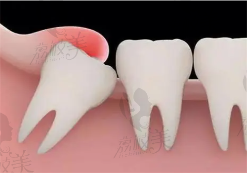 自体牙移植技术成熟吗