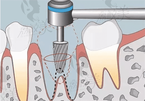 自体牙移植技术成熟吗