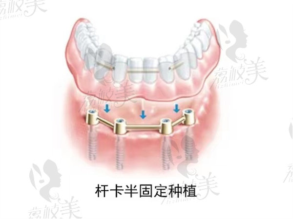 locator种植覆盖义齿的优点