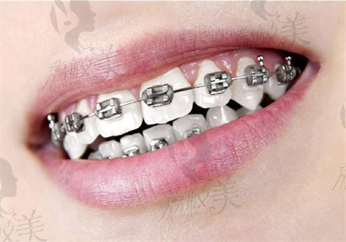 牙齿矫正的方式有哪几种