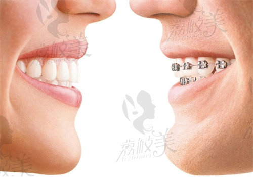 牙齿矫正的方式有哪几种