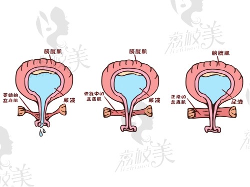 盆底肌恢复黄金时间段