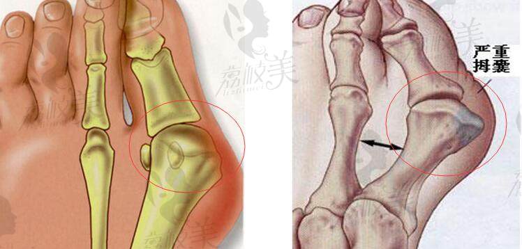 北京圣嘉新醫(yī)療美容醫(yī)院大腳骨手術(shù)分享