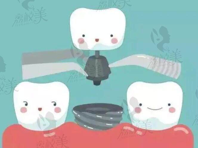 何桃辉医生擅长种植牙、拔牙、全瓷牙、瓷贴面等等口腔问题的修
