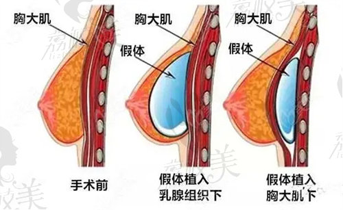 北京嘉禾趙作均醫(yī)生隆胸怎么樣