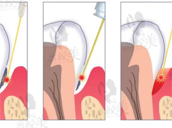 水激光牙周治疗有用吗