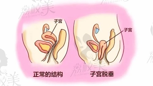 什么是子宫脱垂？
