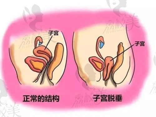子宫脱垂有什么方法恢复正常？
