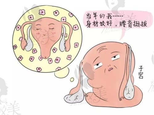 如何正确预防子宫脱垂？