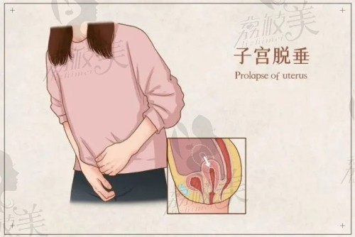 什么是子宫脱垂？