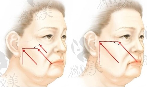 双面网兜手术和筋膜悬吊术区别