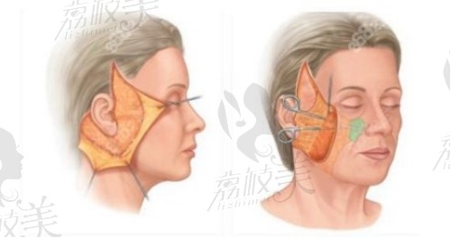 双面网兜手术和筋膜悬吊术区别