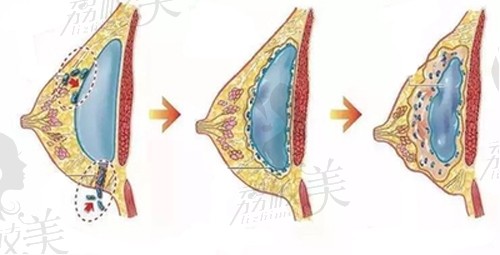 假体隆胸包膜挛缩原因