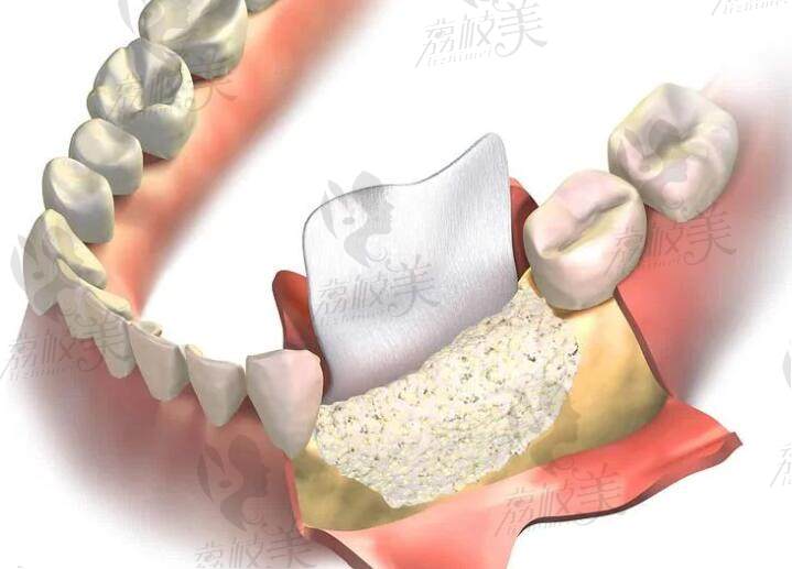 种牙在什么情况下要用到骨粉和骨膜
