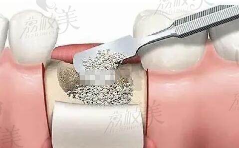 种牙在什么情况下要用到骨粉和骨膜