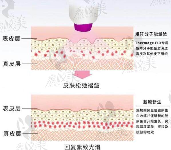 双逆博士和热玛吉的区别在哪