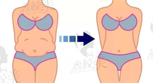 腹壁成形术属于几级手术