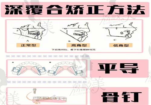 重庆牙齿深覆合矫正图