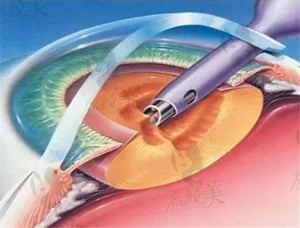 蔡司839mp三焦点人工晶体价格