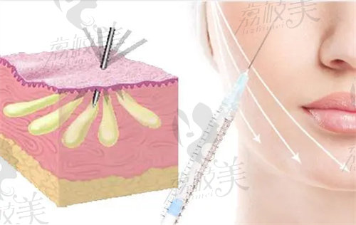 北京美萊自體脂肪填充怎么樣
