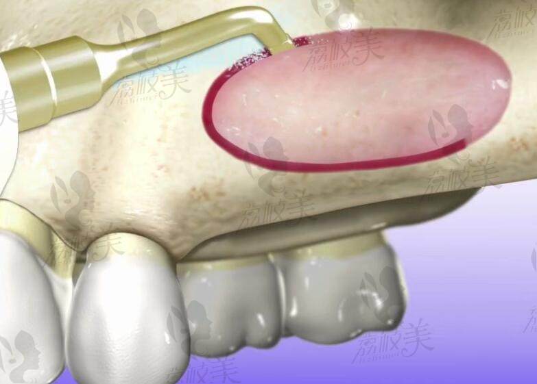上颌窦外提升术（也称为上颌窦开放式提升）根据手术方式