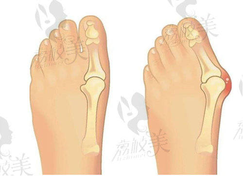 大脚趾外翻是什么原因造成的
