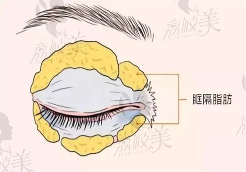 纳米无痕双眼皮和埋线区别