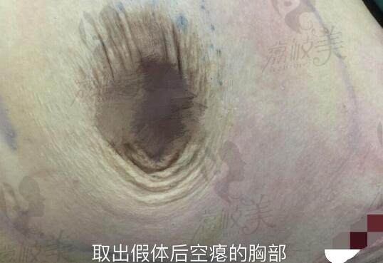 、乳房假体取出后能恢复原来样子吗？不能