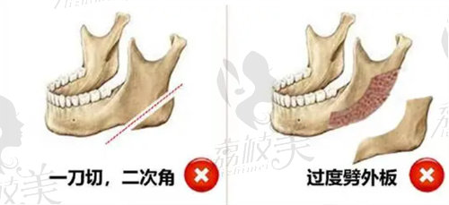 何照华下颌角好