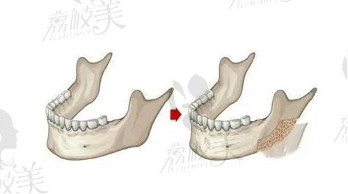 何照華醫(yī)生下頜角手術預約方式