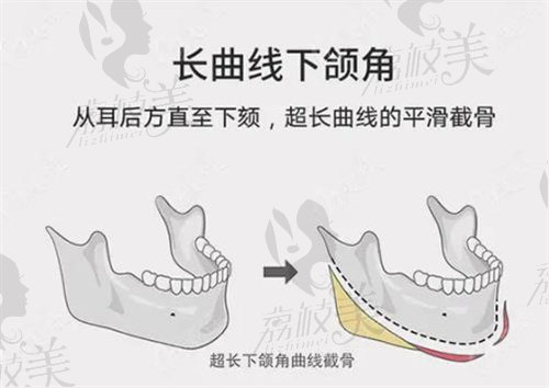 何照華下頜角3d再造術