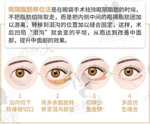 祛眼袋眶隔释放内切还是外切好？