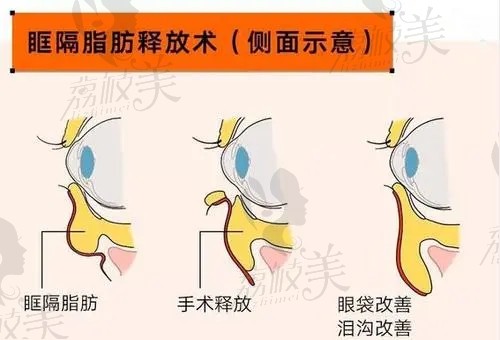 眶隔释放内切和外切区别