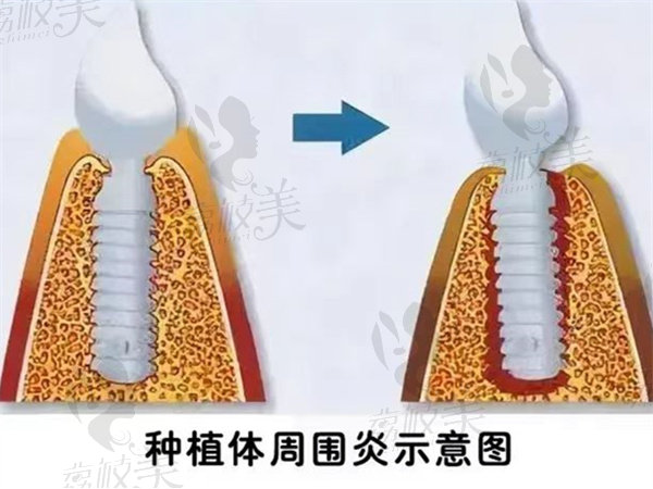得了种植牙周围炎能治好吗