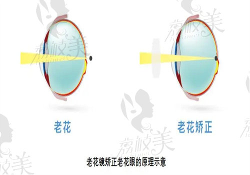 三焦点人工晶体视力能达到多少