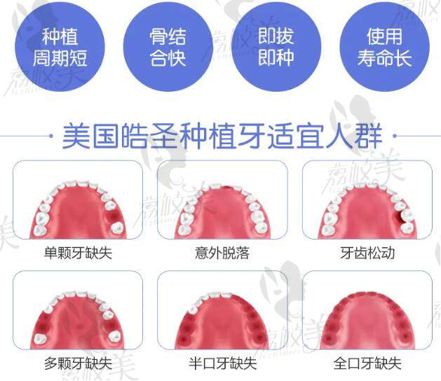 韩国奥齿泰和美国皓圣哪个好