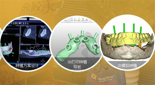 广州德伦口腔数字化种植方案设计