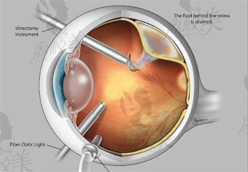 视网膜脱落手术费用大概多少钱