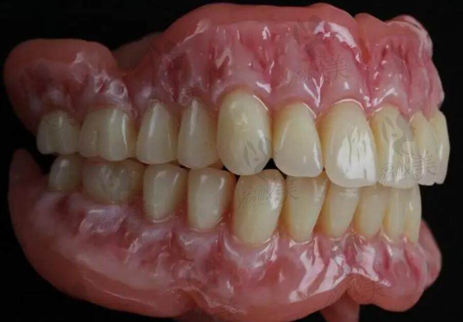 活动义齿和吸附性义齿哪种更舒适一些