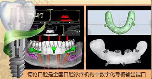 廣州德倫口腔數(shù)字化種植牙