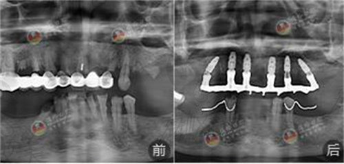广州德伦口腔种植牙CT