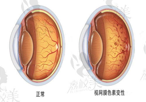 视网膜色素变性治疗哪家医院好